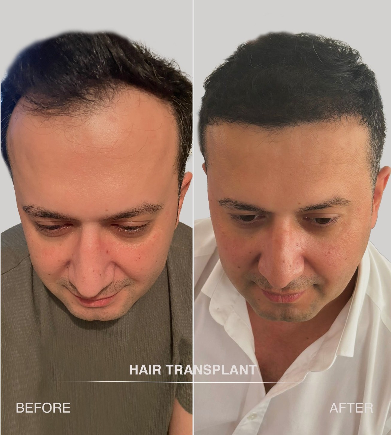 Resultaat 3 haartransplantatie